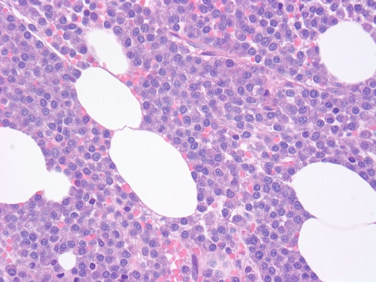 Bone marrow biopsy: Sheets of plasma cells